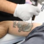 Does Laser tattoo removal work on multicolored tattoos
