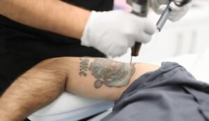 Does Laser tattoo removal work on multicolored tattoos