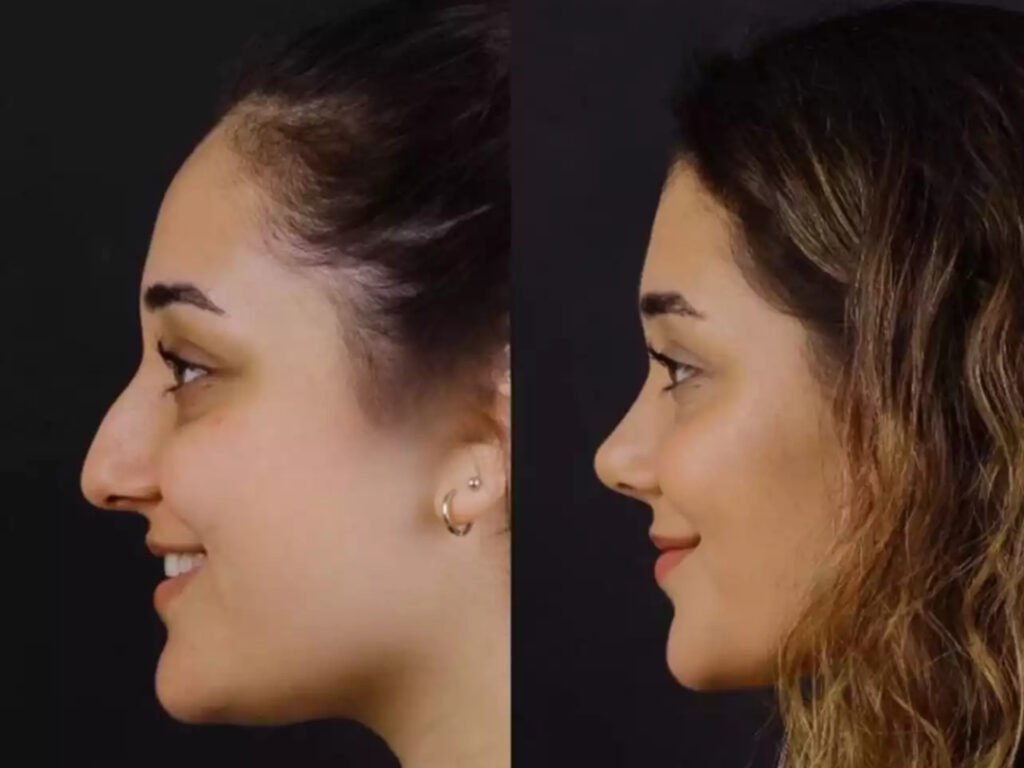 Septoplasty in Dubai