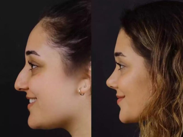 Septoplasty in Dubai