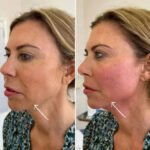 Best Doctors in dubai for Safe Endolift Facial Renewal Treatments