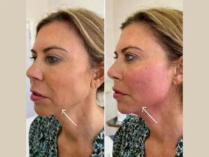 Best Doctors in dubai for Safe Endolift Facial Renewal Treatments