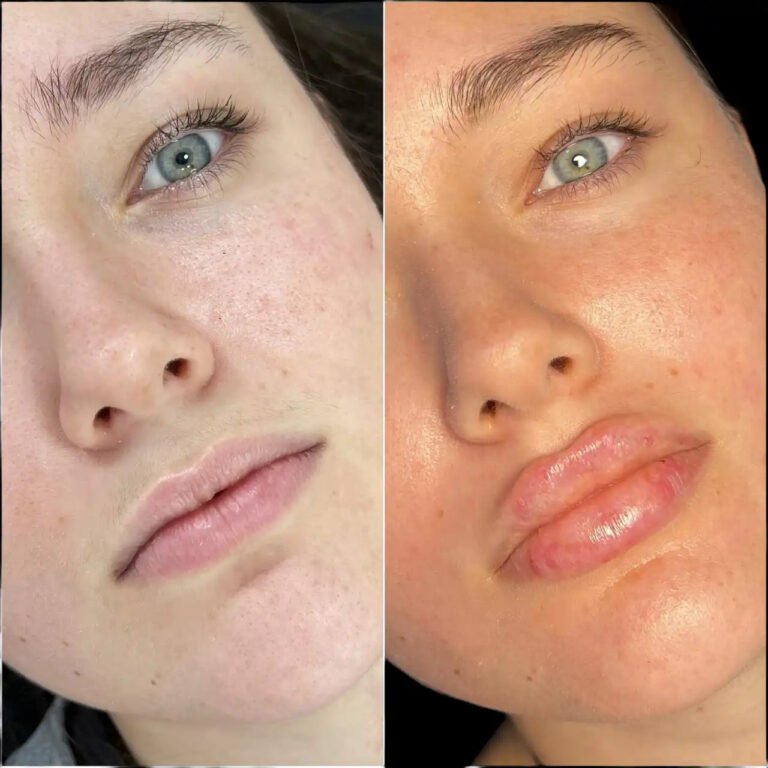 H1-lip-fillers in Dubai (1)