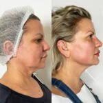 Endolift Treatment in Dubai for Personalized Facial Rejuvenation Results