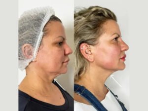 Best Doctors in dubai for Endolift Treatment Preparation and Aftercare