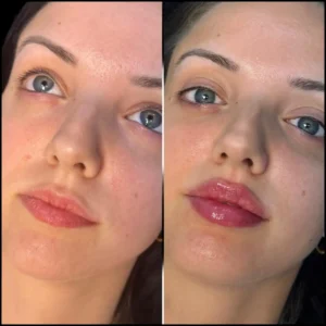 H5-lip-fillers in Dubaiiii