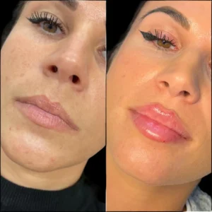 H6-lip-fillers in dubai