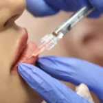 How Can Lip Fillers Improve Lip Symmetry