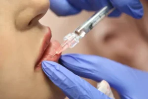 How Can Lip Fillers Improve Lip Symmetry