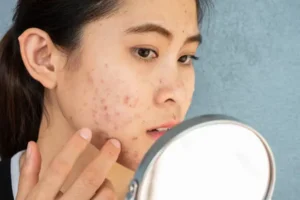 How Does Acne Treatment Support Smoother-Looking Skin