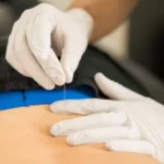 How Dry Needling Therapy Helps Relieve Muscle Pain Naturally