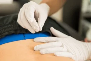 How Dry Needling Therapy Helps Relieve Muscle Pain Naturally