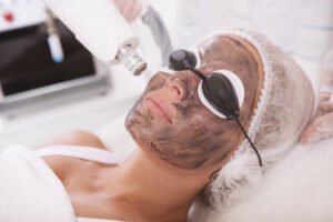How Laser Carbon Peel Improve Skin Texture