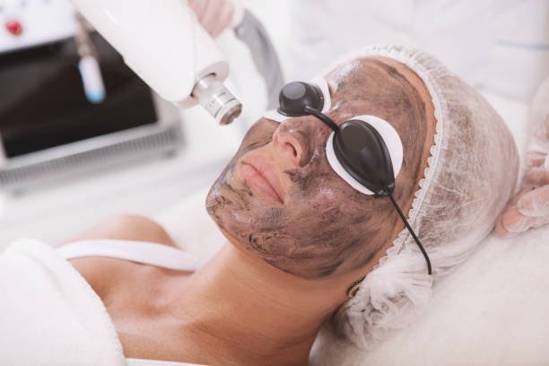 How Laser Carbon Peel Improve Skin Texture