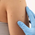 Is Mole Removal Right for Your Skin Concerns
