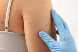 Is Mole Removal Right for Your Skin Concerns