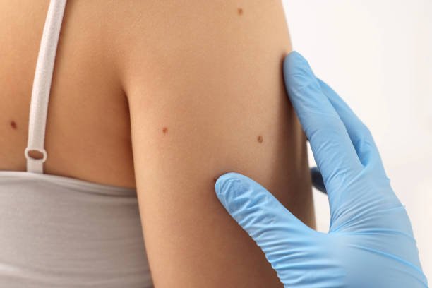 Is Mole Removal Right for Your Skin Concerns
