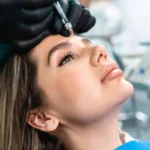 Is PRP Treatment Effective for Fine Lines