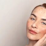 Skin Pigmentation Treatment In Dubai