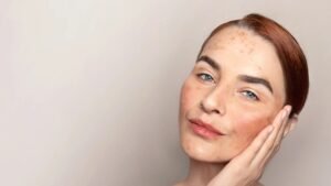 Skin Pigmentation Treatment In Dubai
