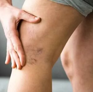 Varicose Veins Treatment in Dubai