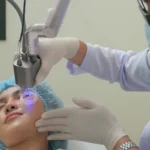 What Can Pico Laser Treatment Fade Dark Spots