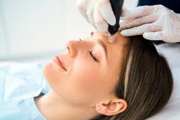 What Does Microneedling Treatment Do for Pores