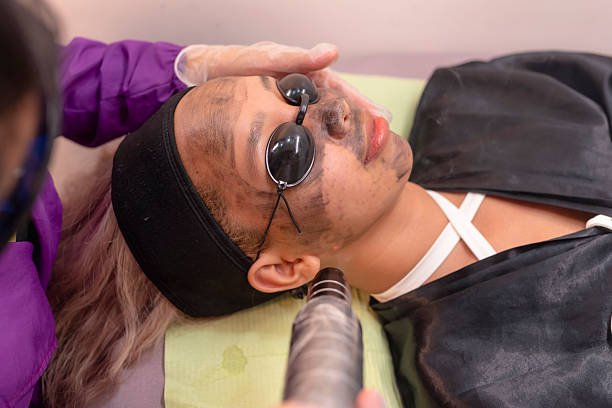 What makes Laser carbon peel useful for skin refinement