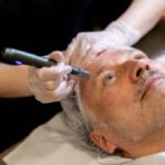 What should you know before Microneedling treatment