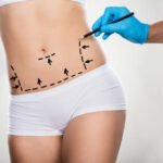 Can Mini Tummy Tuck Address Stubborn Lower Belly Skin
