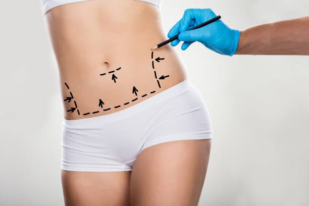Can Mini Tummy Tuck Address Stubborn Lower Belly Skin