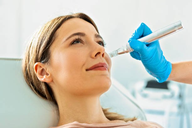 Does Fractional RF Micro Needling Improve Skin Tone