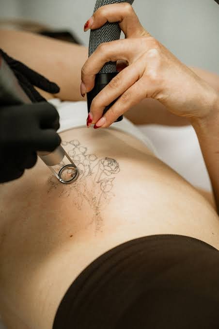 Does Laser Tattoo Removal Hurt During Treatment