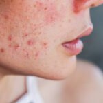 How Can Acne Treatment Help Improve Skin Texture