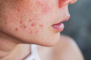 How Can Acne Treatment Help Improve Skin Texture