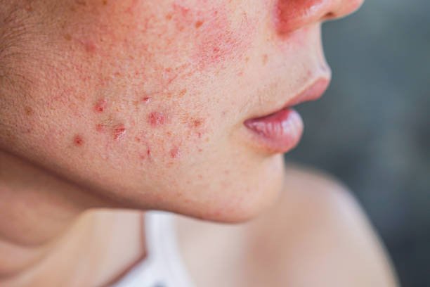 How Can Acne Treatment Help Improve Skin Texture