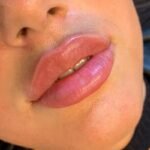 How Do Russian Lip Fillers Add Lip Height