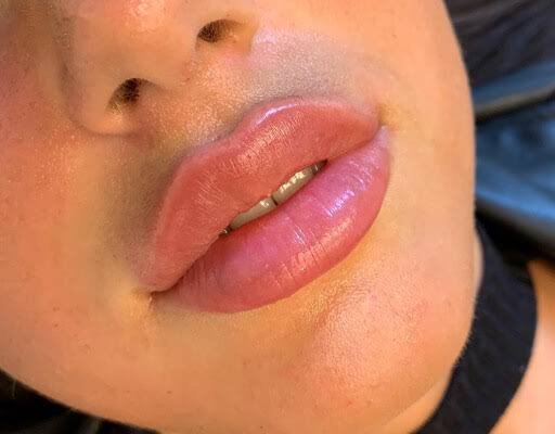 How Do Russian Lip Fillers Add Lip Height