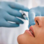 How Do Russian Lip Fillers Shape the Upper Lip