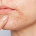 How Does Acne Treatment Target Deep Pimples
