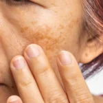 How Does Melasma Treatment Target Facial Pigmentation
