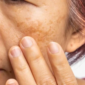 How Does Melasma Treatment Target Facial Pigmentation