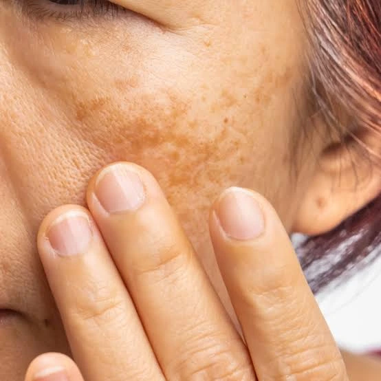 How Does Melasma Treatment Target Facial Pigmentation