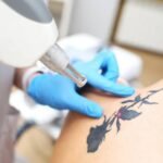 How can Laser Tattoo Removal support a clearer skin appearance