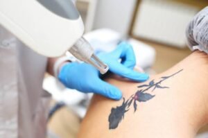 How can Laser Tattoo Removal support a clearer skin appearance