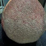 How does DHI Hair Transplant support natural hair density