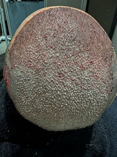How does DHI Hair Transplant support natural hair density