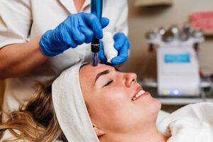 Is Fractional RF Micro Needling Effective for Acne Scars