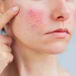 Is Laser Acne Scar treatment Suitable for Oily Skin