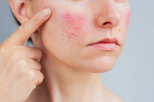 Is Laser Acne Scar treatment Suitable for Oily Skin
